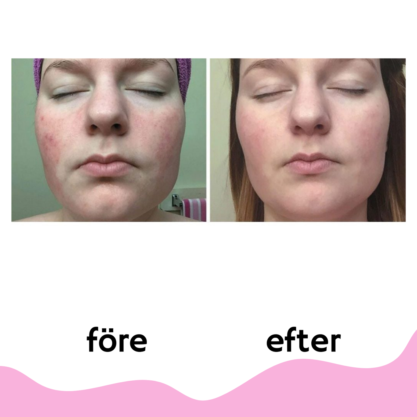 InfraMask™ Red Light Therapy Mask
